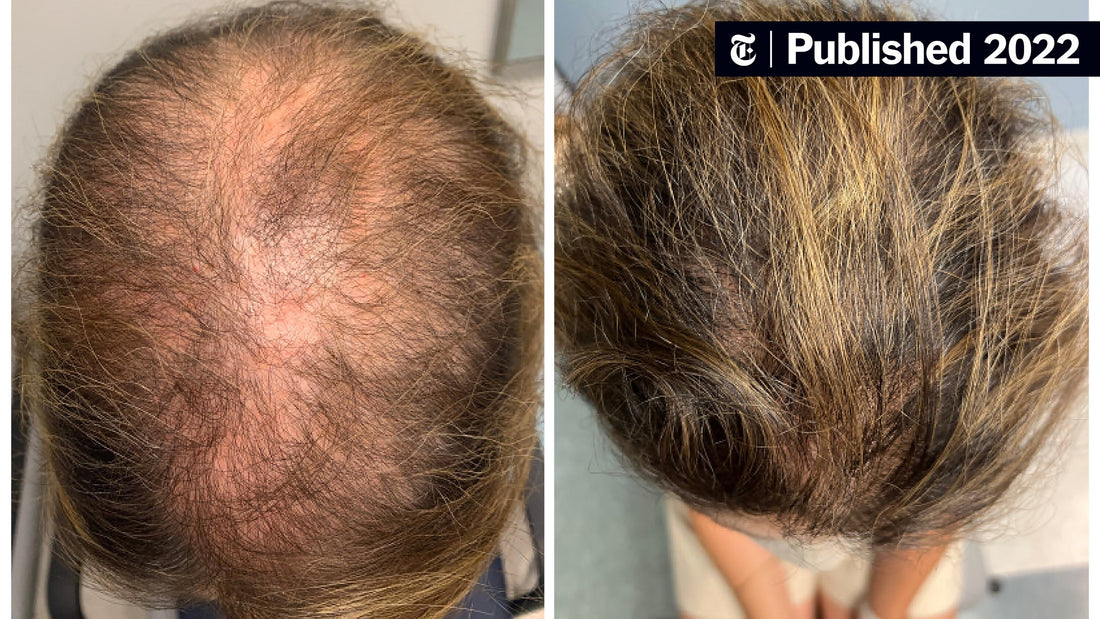 Why Your Hair Loss Treatments Failed (And What Actually Works)