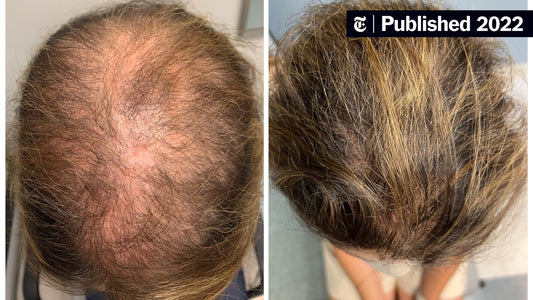 Why Your Hair Loss Treatments Failed (And What Actually Works)