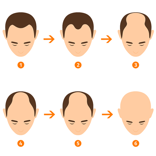 The Complete Guide to Stopping Male Pattern Baldness (Evidence-Based Strategies)
