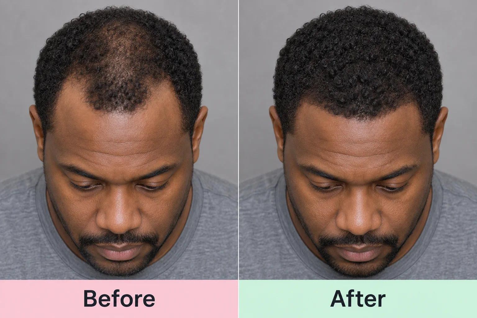 Illustrative before-and-after comparison of thinning temples and fuller hair density; not actual customer results